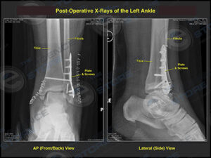 Accident Injuries: What is Open Reduction and Internal Fixation?