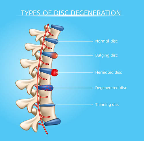 NJ Personal Injury Settlements for Herniated Disc