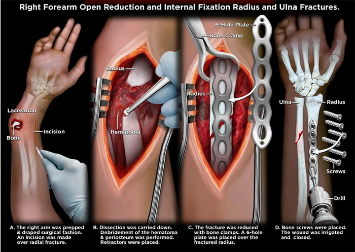 Open Reduction Internal Fixation Surgery